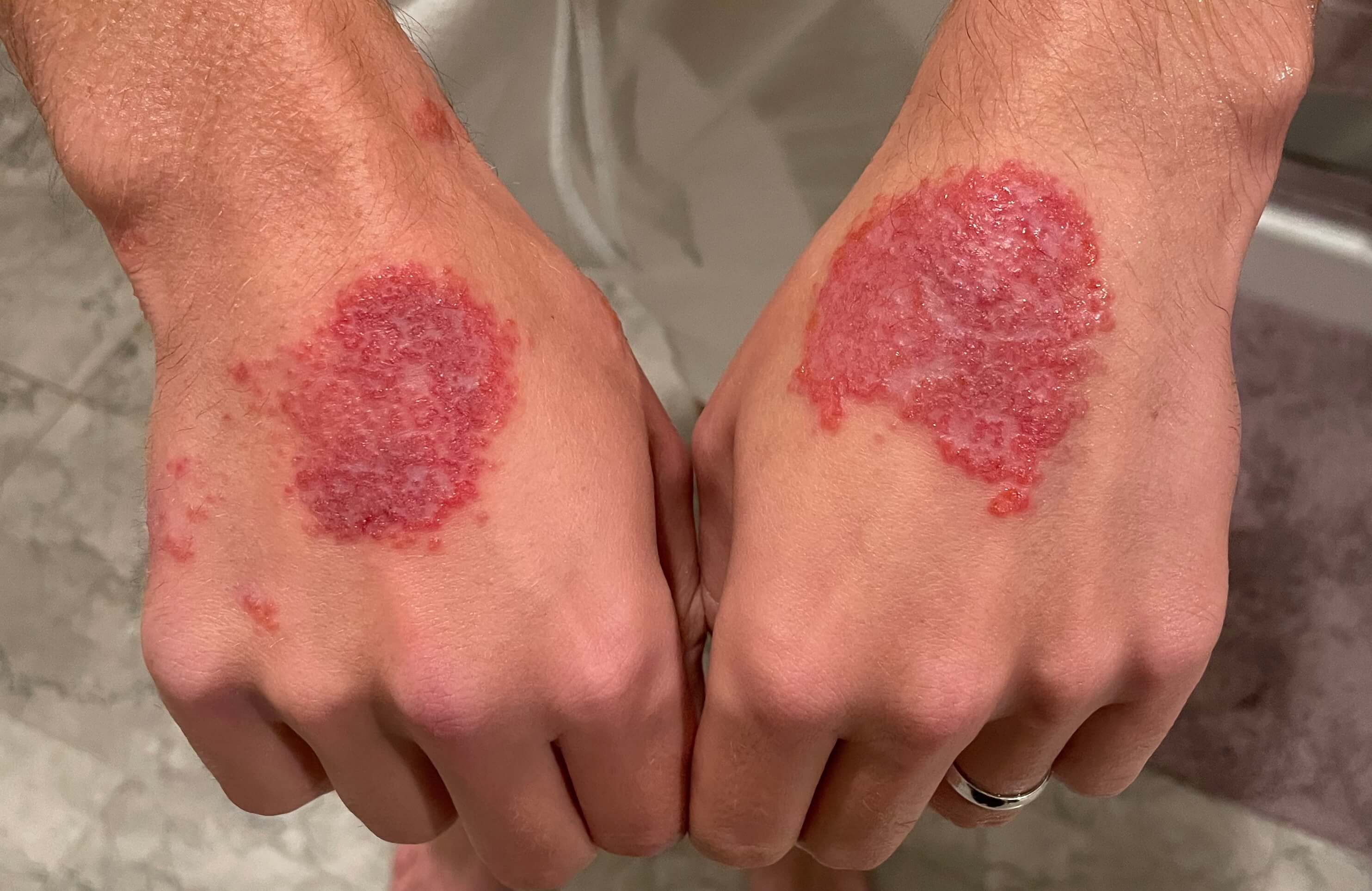 Cover Image for Healing atopic dermatitis with a low vitamin A diet